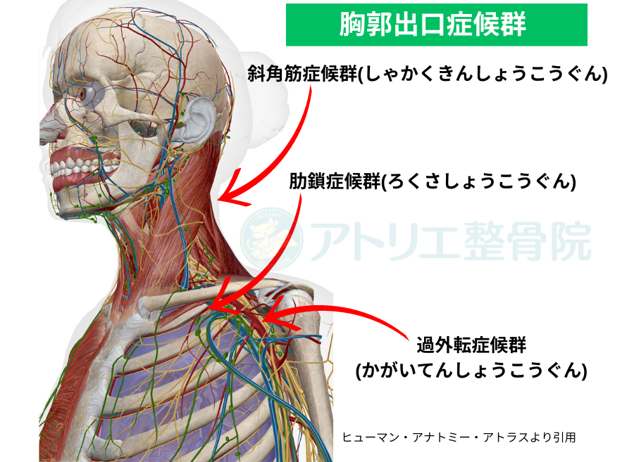 板橋の整体アトリエ整骨院の胸郭出口症候群の図